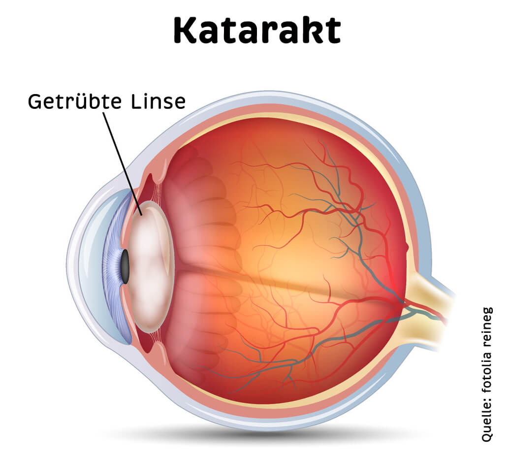 Katarakt Op Auge